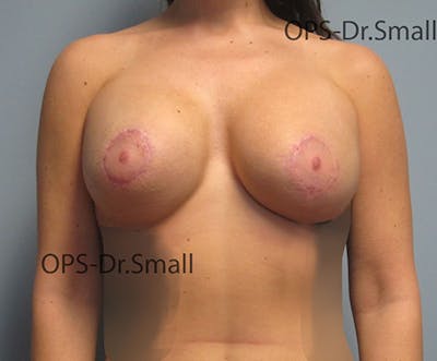 Revision Surgery Before & After Gallery - Patient 337629 - Image 2