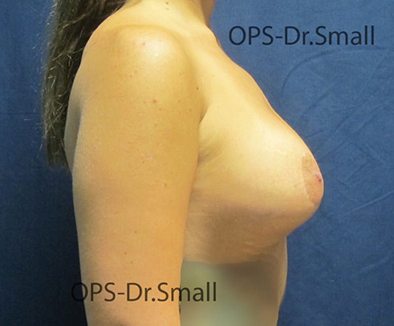 Revision Surgery Before & After Gallery - Patient 337629 - Image 5