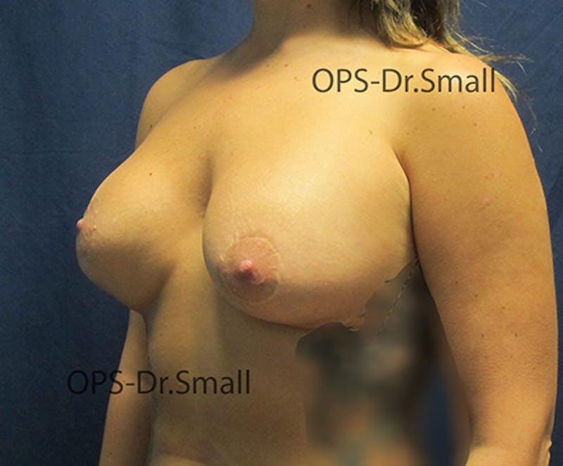 Revision Surgery Before & After Gallery - Patient 337629 - Image 7