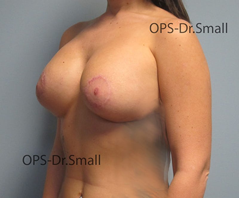 Revision Surgery Before & After Gallery - Patient 337629 - Image 8
