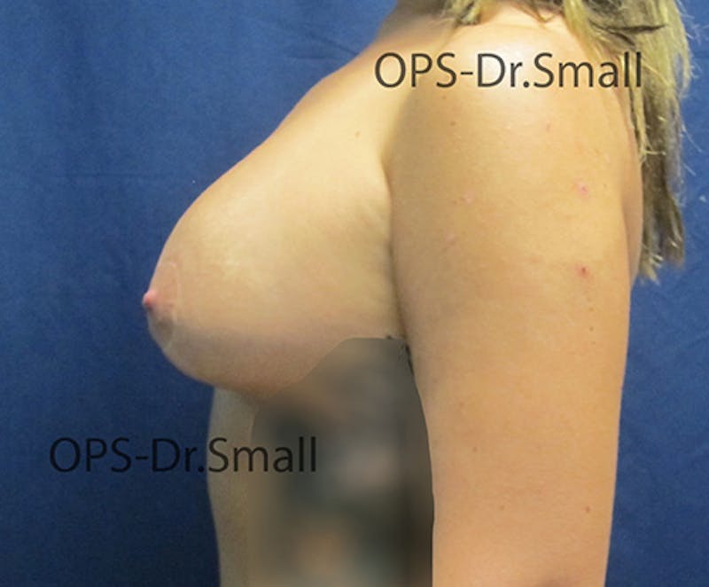 Revision Surgery Before & After Gallery - Patient 337629 - Image 9