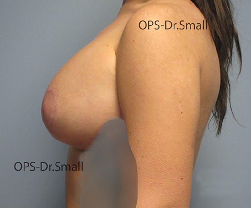 Revision Surgery Before & After Gallery - Patient 337629 - Image 10