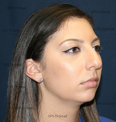 Rhinoplasty (Nose Job) Before & After Gallery - Patient 226377 - Image 1