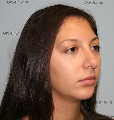 Rhinoplasty (Nose Job) Before & After Gallery - Patient 226377 - Image 2