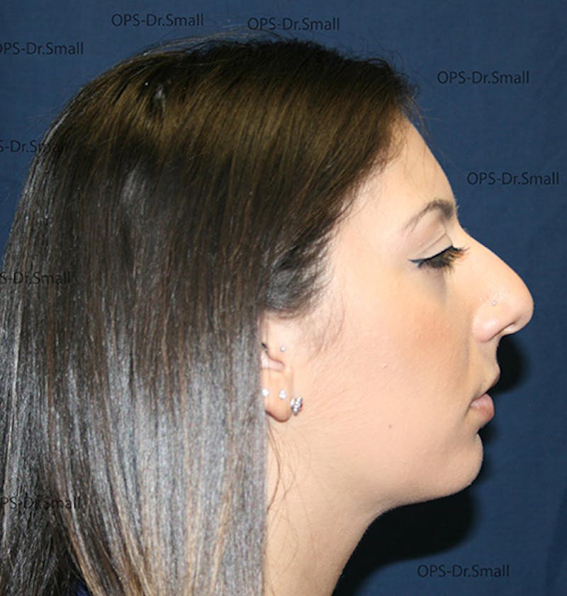 Rhinoplasty (Nose Job) Before & After Gallery - Patient 226377 - Image 3