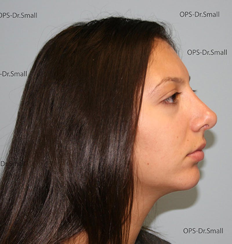 Rhinoplasty (Nose Job) Before & After Gallery - Patient 226377 - Image 4