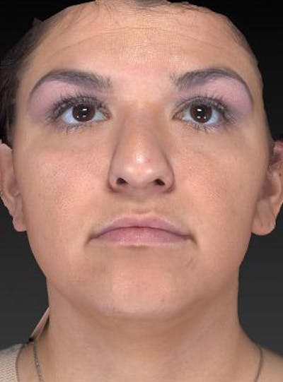 Rhinoplasty (Nose Job) Before & After Gallery - Patient 189136 - Image 1