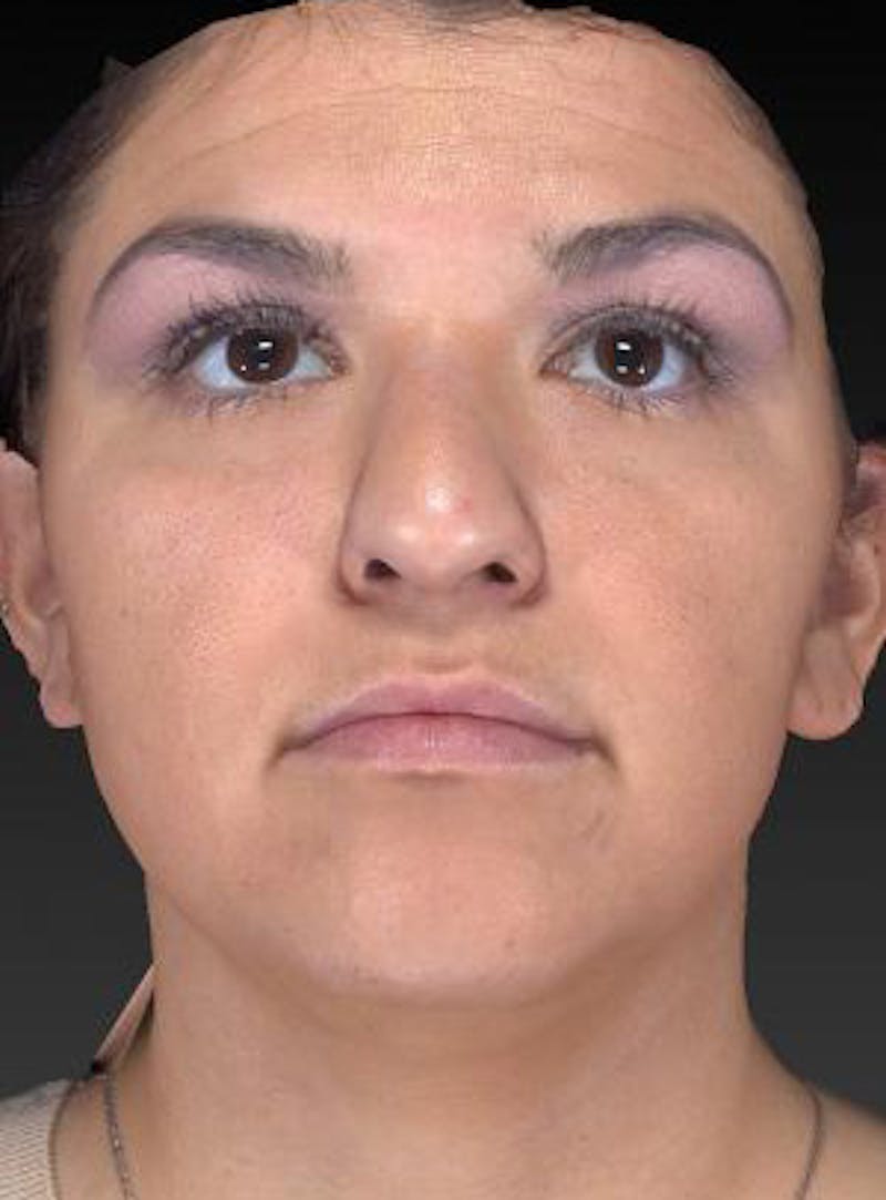 Rhinoplasty (Nose Job) Before & After Gallery - Patient 189136 - Image 1
