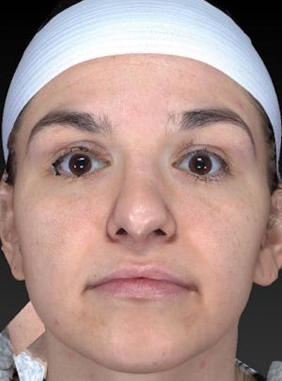 Rhinoplasty (Nose Job) Before & After Gallery - Patient 189136 - Image 2