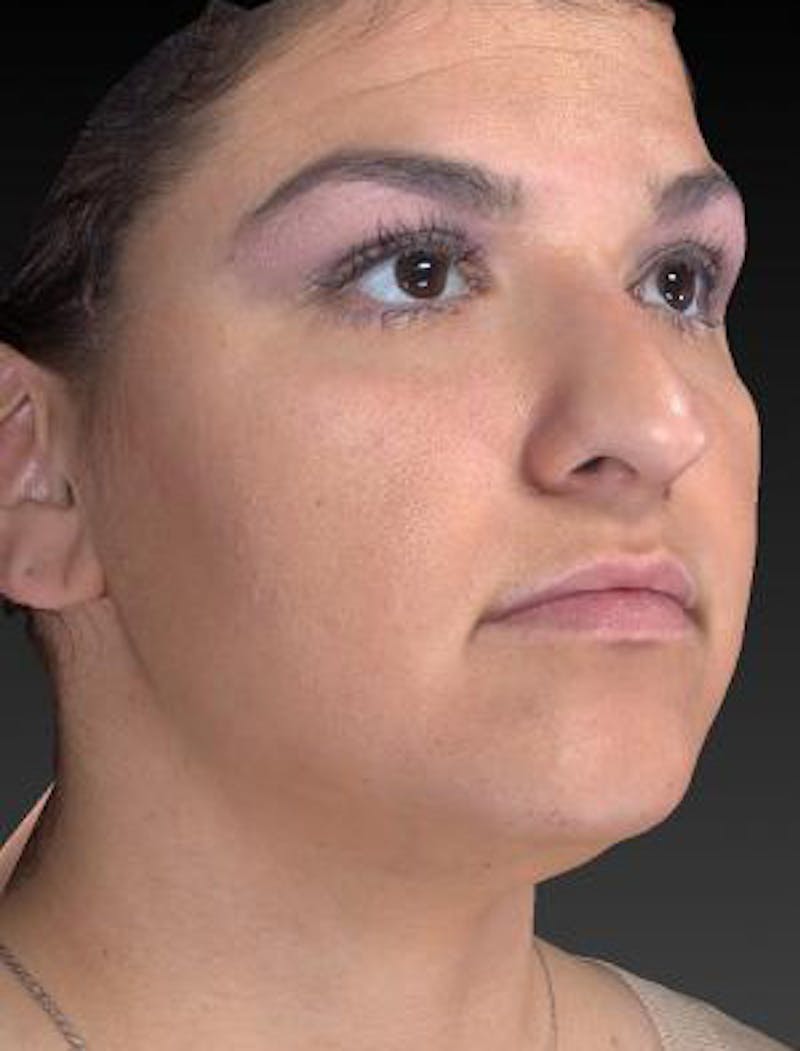 Rhinoplasty (Nose Job) Before & After Gallery - Patient 189136 - Image 3