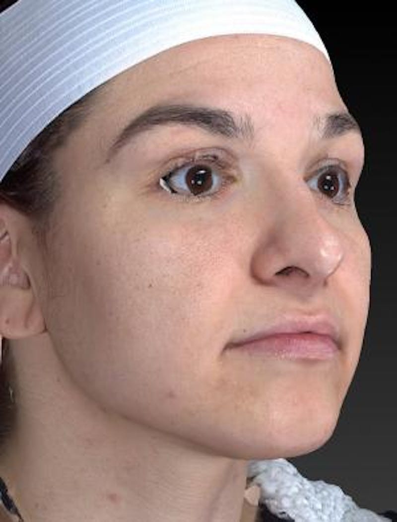 Rhinoplasty (Nose Job) Before & After Gallery - Patient 189136 - Image 4