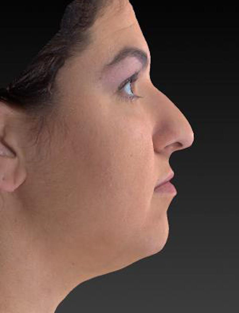 Rhinoplasty (Nose Job) Before & After Gallery - Patient 189136 - Image 5