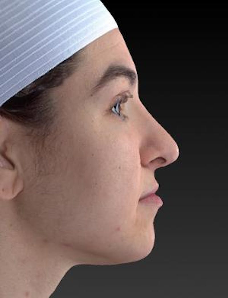 Rhinoplasty (Nose Job) Before & After Gallery - Patient 189136 - Image 6