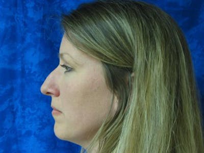 Rhinoplasty (Nose Job) Before & After Gallery - Patient 939508 - Image 1