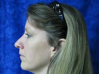Rhinoplasty (Nose Job) Before & After Gallery - Patient 939508 - Image 2