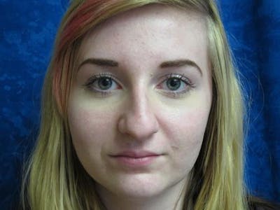 Rhinoplasty (Nose Job) Before & After Gallery - Patient 376744 - Image 1