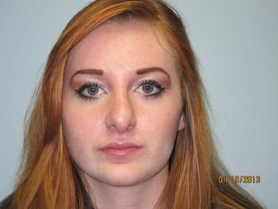 Rhinoplasty (Nose Job) Before & After Gallery - Patient 376744 - Image 2