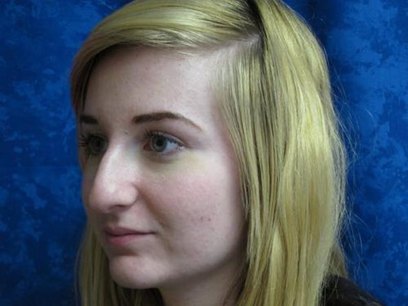 Rhinoplasty (Nose Job) Before & After Gallery - Patient 376744 - Image 3