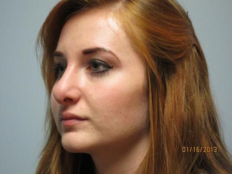 Rhinoplasty (Nose Job) Before & After Gallery - Patient 376744 - Image 4