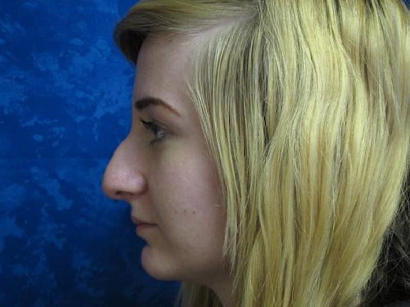 Rhinoplasty (Nose Job) Before & After Gallery - Patient 376744 - Image 5