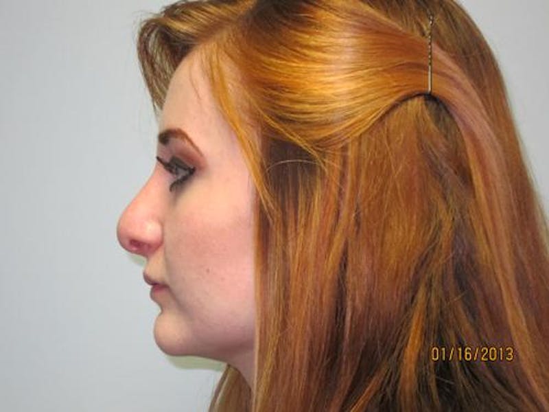 Rhinoplasty (Nose Job) Before & After Gallery - Patient 376744 - Image 6