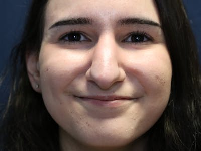 Rhinoplasty (Nose Job) Before & After Gallery - Patient 937682 - Image 1