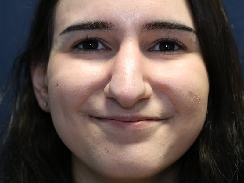 Rhinoplasty (Nose Job) Before & After Gallery - Patient 937682 - Image 1