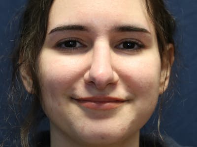 Rhinoplasty (Nose Job) Before & After Gallery - Patient 937682 - Image 2