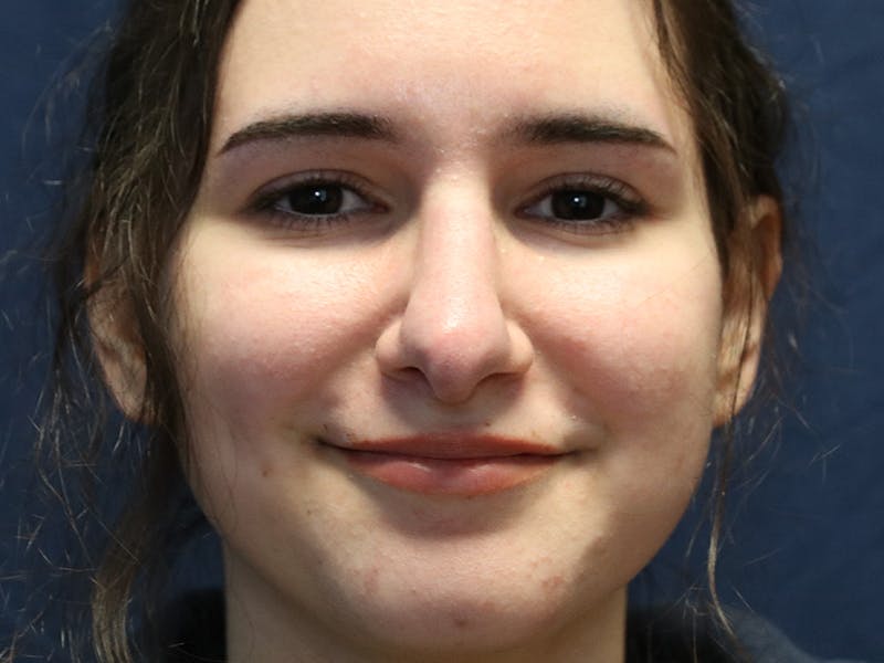 Rhinoplasty (Nose Job) Before & After Gallery - Patient 937682 - Image 2