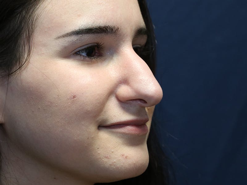 Rhinoplasty (Nose Job) Before & After Gallery - Patient 937682 - Image 3