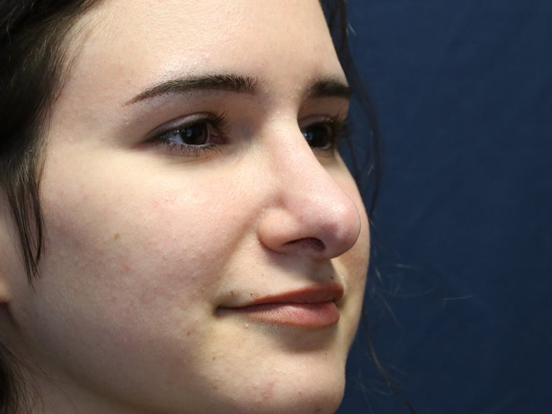 Rhinoplasty (Nose Job) Before & After Gallery - Patient 937682 - Image 4
