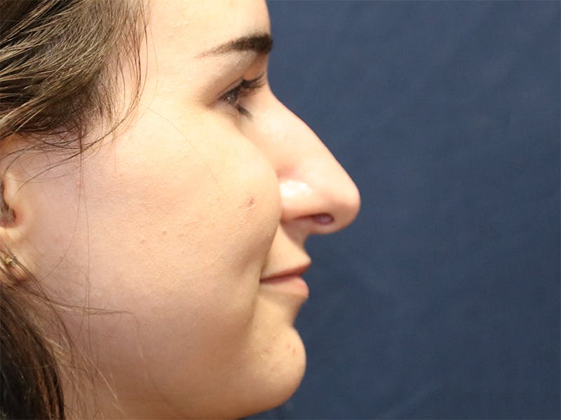 Rhinoplasty (Nose Job) Before & After Gallery - Patient 937682 - Image 5