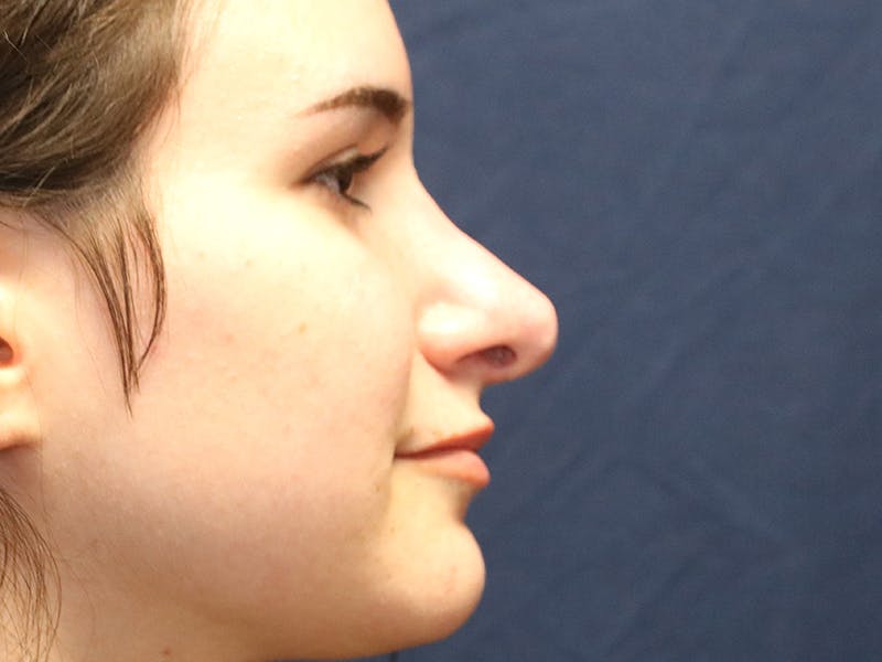 Rhinoplasty (Nose Job) Before & After Gallery - Patient 937682 - Image 6