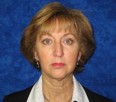 Facelift Before & After Gallery - Patient 327613 - Image 1