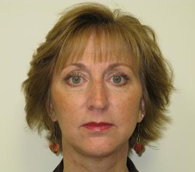 Facelift Before & After Gallery - Patient 327613 - Image 2