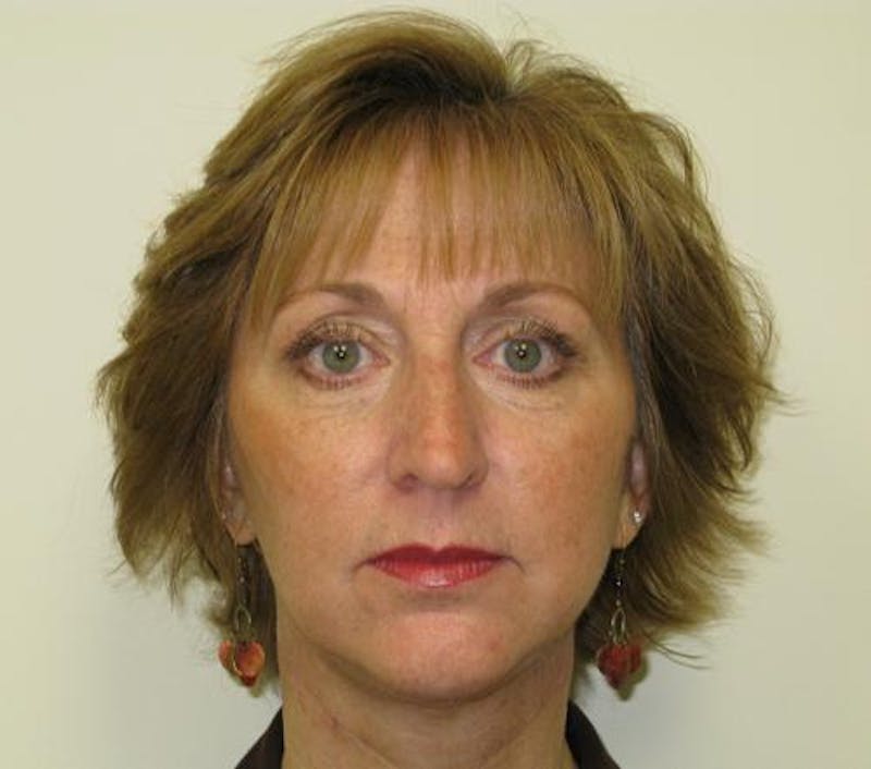 Facelift Before & After Gallery - Patient 327613 - Image 2