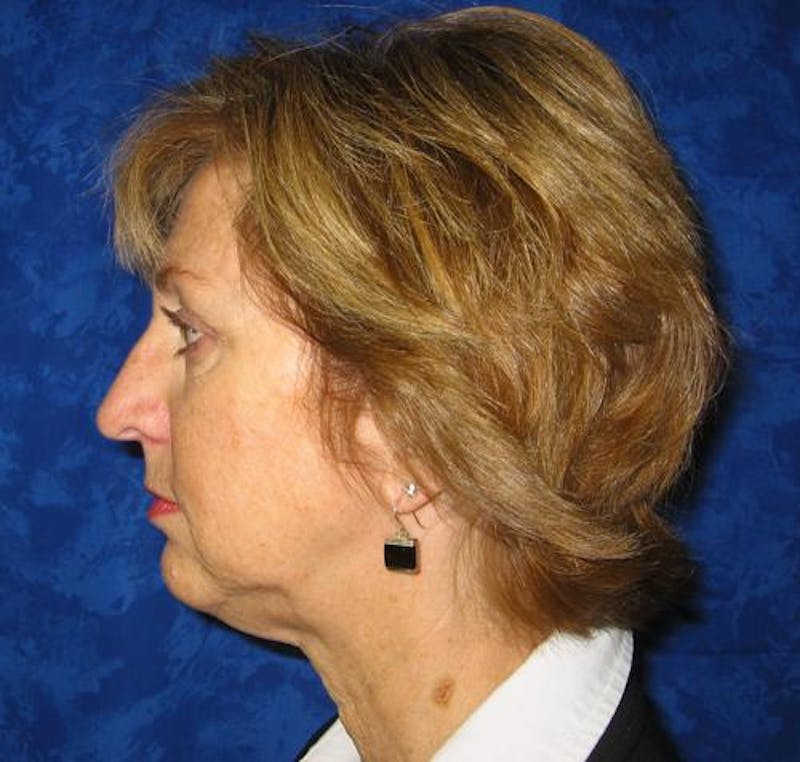 Facelift Before & After Gallery - Patient 327613 - Image 5