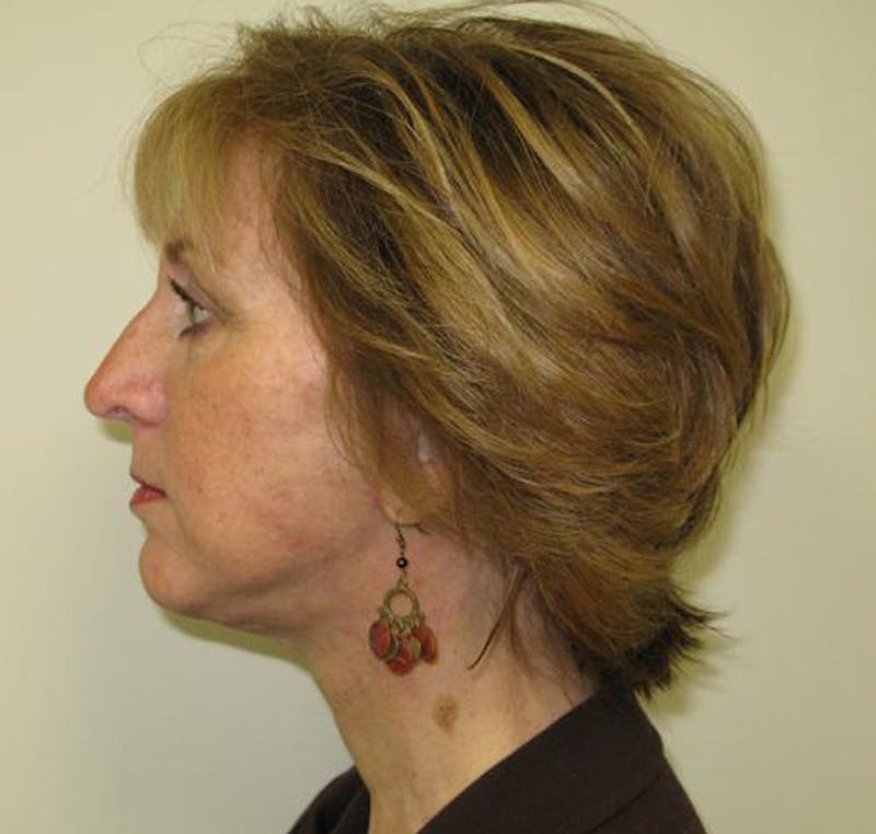 Facelift Before & After Gallery - Patient 327613 - Image 6