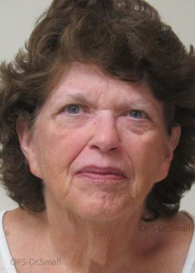 Facelift Before & After Gallery - Patient 356831 - Image 1