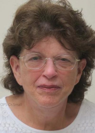 Facelift Before & After Gallery - Patient 356831 - Image 2