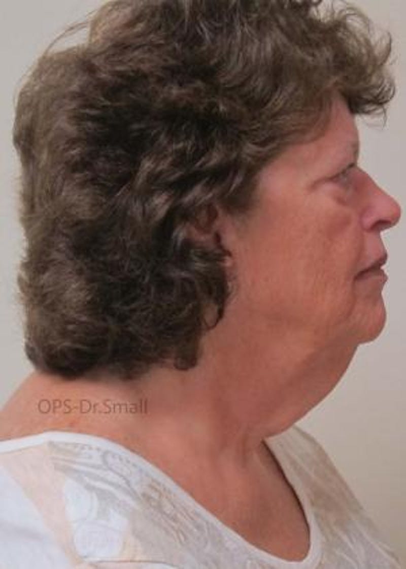 Facelift Before & After Gallery - Patient 356831 - Image 3
