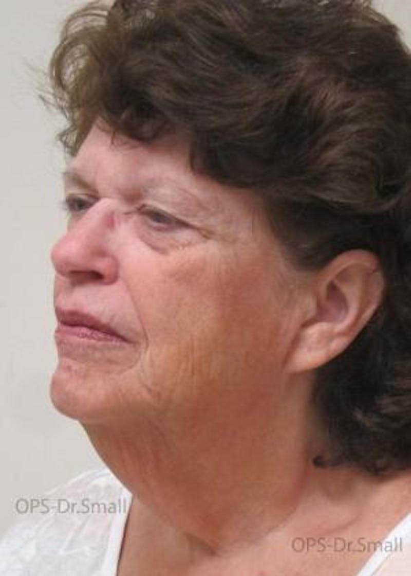 Facelift Before & After Gallery - Patient 356831 - Image 5