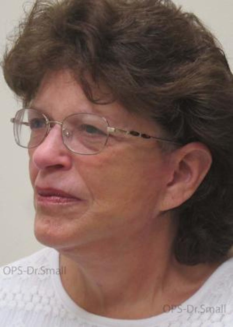 Facelift Before & After Gallery - Patient 356831 - Image 6