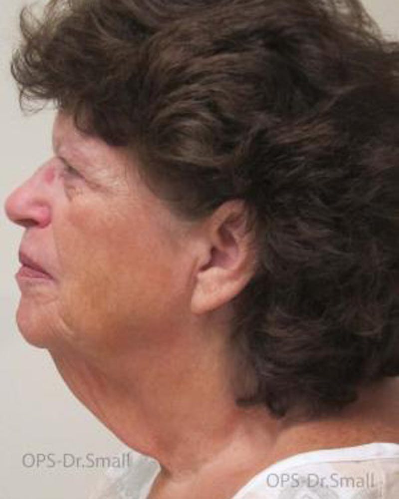 Facelift Before & After Gallery - Patient 356831 - Image 7