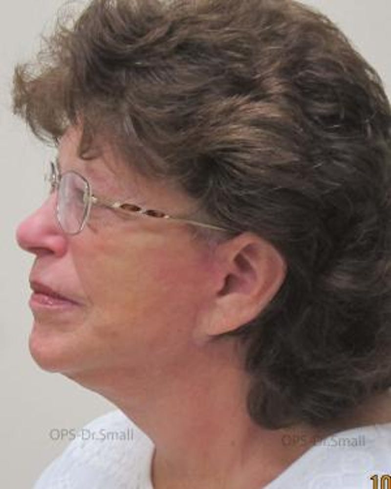 Facelift Before & After Gallery - Patient 356831 - Image 8
