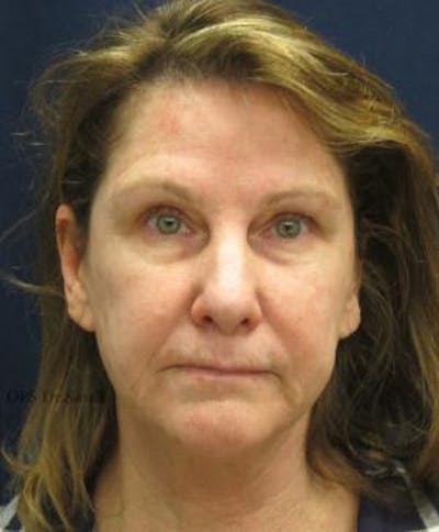 Facelift Before & After Gallery - Patient 104805 - Image 1