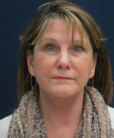 Facelift Before & After Gallery - Patient 104805 - Image 2