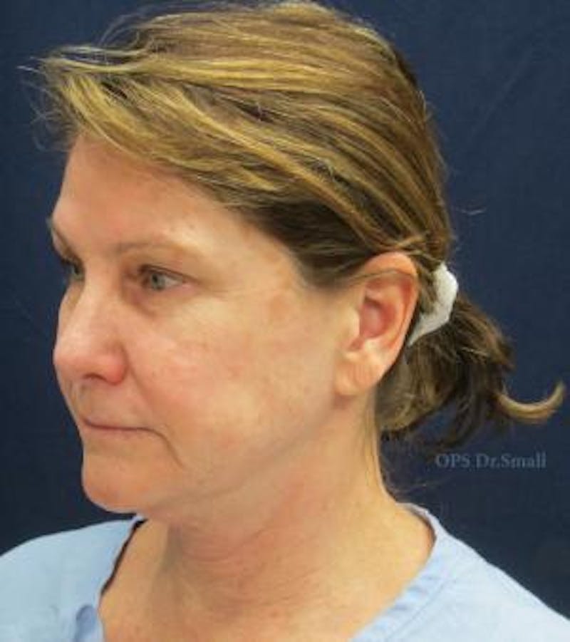Facelift Before & After Gallery - Patient 104805 - Image 3
