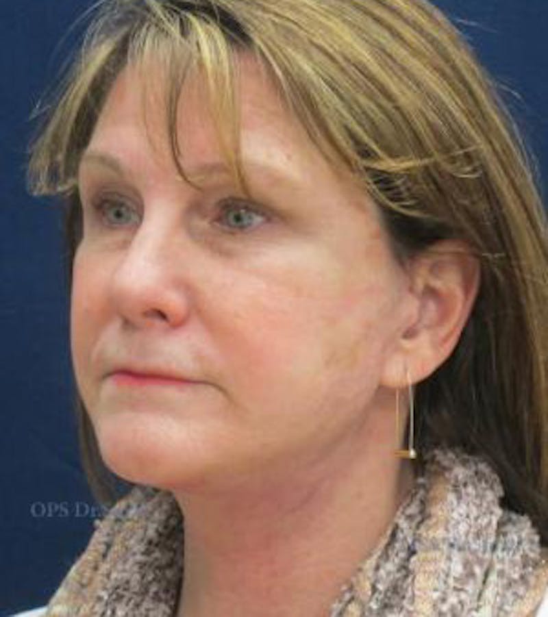 Facelift Before & After Gallery - Patient 104805 - Image 4