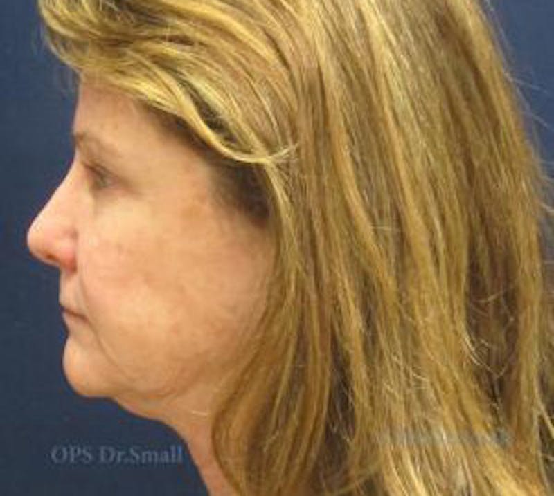 Facelift Before & After Gallery - Patient 104805 - Image 5